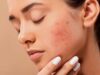 चेहरे पर बार-बार मुंहासे? समझ लें शरीर दे रहा है इन गंभीर समस्याओं का अलर्ट