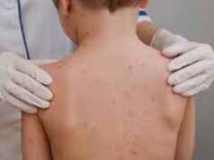 मध्य प्रदेश में खसरे का खतरा बढ़ा, 4 जिलों में 12 केस मिले; घर-घर सर्वे शुरू