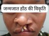 जन्मजात होंठ की विकृति का हुआ सफल उपचार, अब सामान्य जीवन जी रही हैं 22 वर्षीय युवती